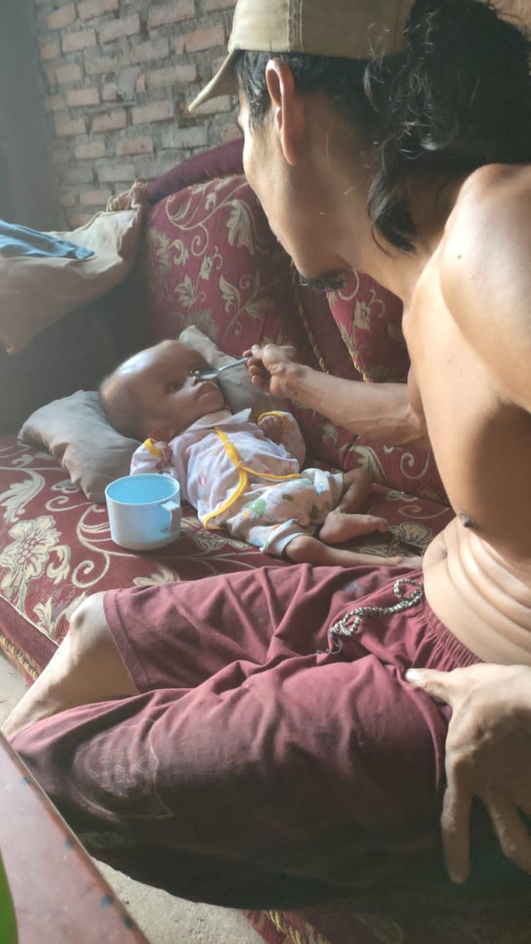 Bocah 7 Tahun di Lamtim Terserang Hidrosefalus Butuh Perhatian Dari Pemerintah