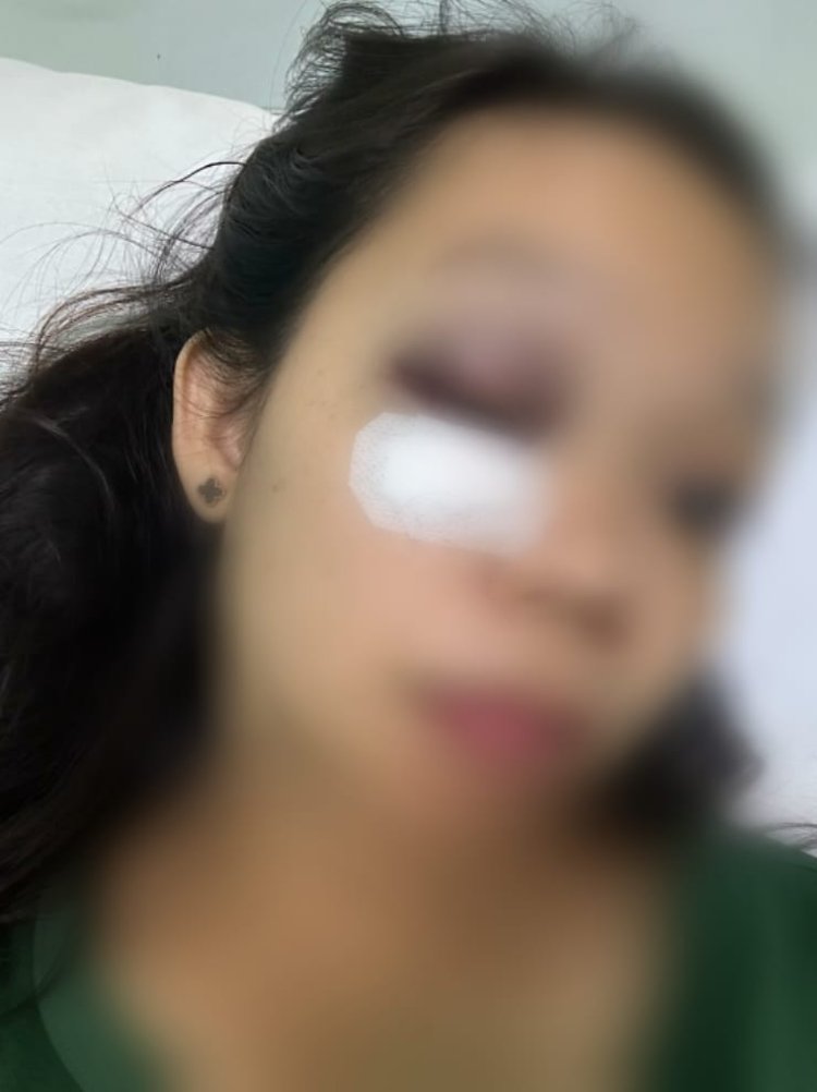 Ungkap Perselingkuhan Suami Berprofesi Polri, Istri Nyaris Buta Dianiaya